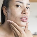 Moisturizing for Acne-Prone Skin: Everything You Need to Know