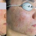 Understanding the Benefits of Red Light Therapy for Acne Treatment