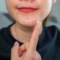 Benzoyl Peroxide for Acne: Professional and Effective Solutions