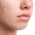 Stress and Acne: Understanding the Relationship and Finding Effective Solutions