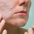 Understanding Benzoyl Peroxide for Acne Treatment