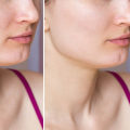 Understanding Isotretinoin: A Comprehensive Guide to Treating Acne in NYC
