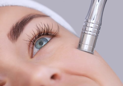 Exploring the Benefits of Microdermabrasion for Acne Treatment
