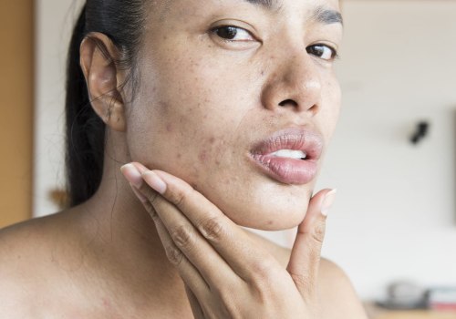 Moisturizing for Acne-Prone Skin: Everything You Need to Know