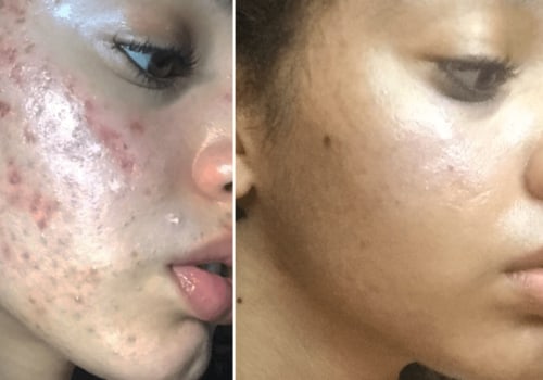 Cleansing Routine for Acne-Prone Skin: Tips for Clearer Skin