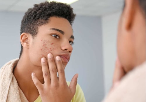 Exploring Antibiotics for Treating Acne