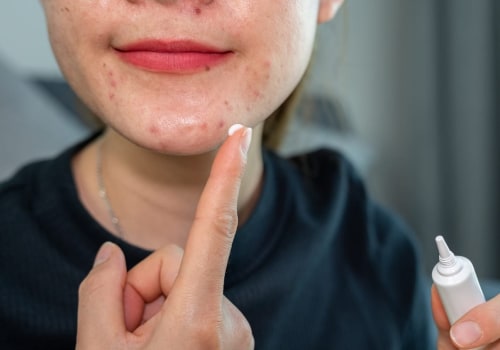 Benzoyl Peroxide for Acne: Professional and Effective Solutions