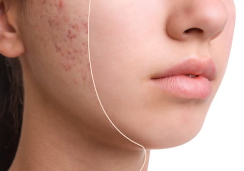 Stress and Acne: Understanding the Relationship and Finding Effective Solutions