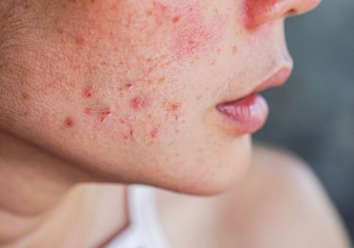 Understanding the Menstrual Cycle and Its Effects on Acne