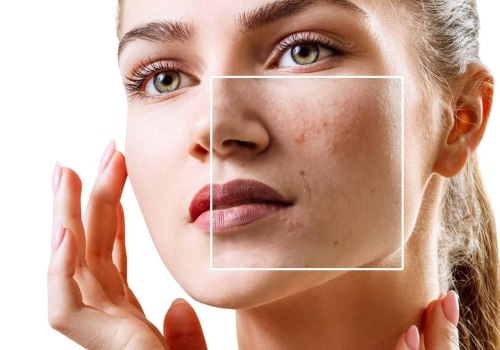Diet and Acne: Understanding Causes, Prevention, and Treatment in NYC