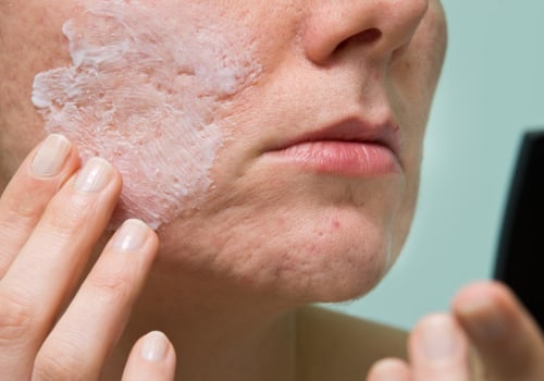 Understanding Benzoyl Peroxide for Acne Treatment